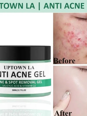 Uptown La Acne Scar Removal Exfoliating Gel