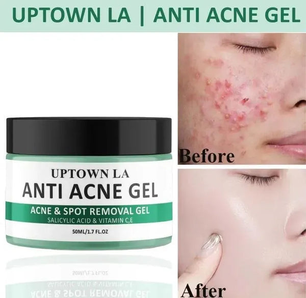 Uptown La Acne Scar Removal Exfoliating Gel