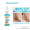 Skin Brightening Anti-Acne Serum, 30 Ml